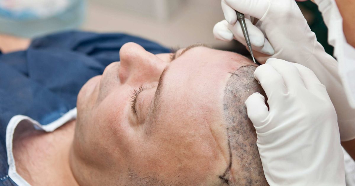 Hair Transplant Surgery