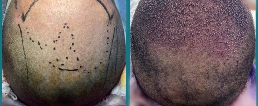 Best Hair Transplant in Lahore : Institute Cosmetique