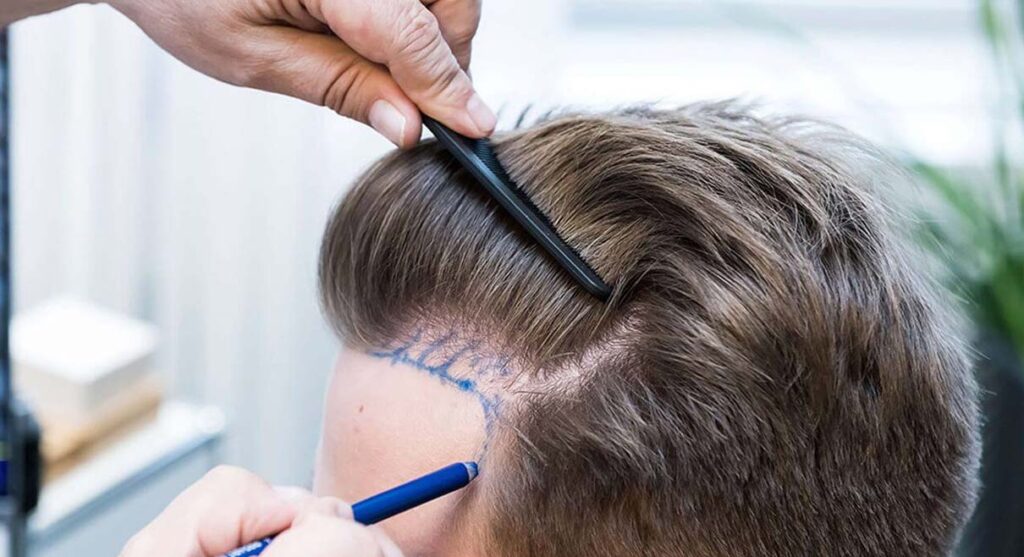 Hair transplant specialist planning a personalized treatment for natural hair restoration.