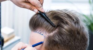 Hair transplant specialist planning a personalized treatment for natural hair restoration.