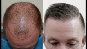 Hair specialist examining a patient's scalp during a follow-up visit after a hair transplant