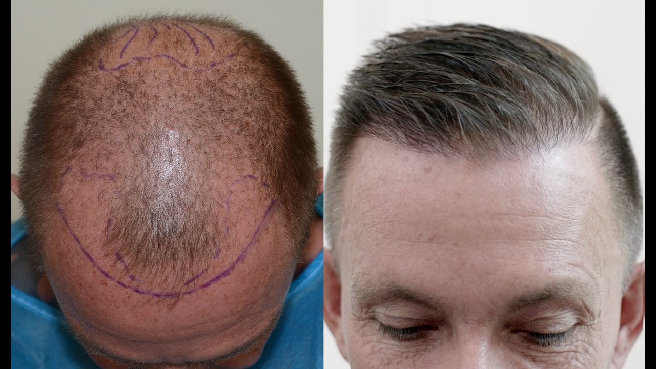 Can Hair Loss Continue After a Hair Transplant?